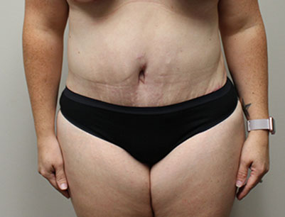 Tummy Tuck before and after - after