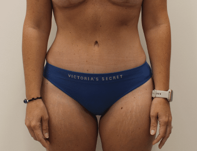 Tummy Tuck before and after - after