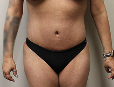 Tummy Tuck before and after - after