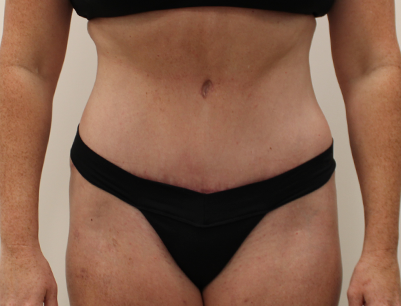 Tummy Tuck before and after - after