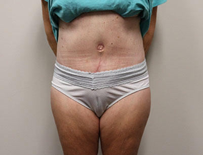Tummy Tuck before and after - after