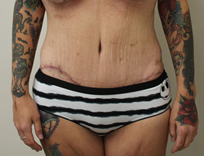 Tummy Tuck before and after - after