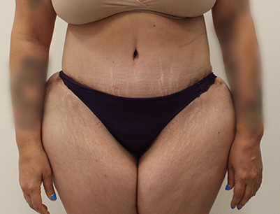 Tummy Tuck before and after - after