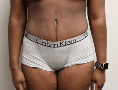 Tummy Tuck before and after - after