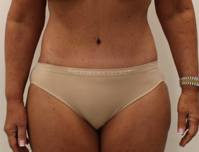 Tummy Tuck before and after - after