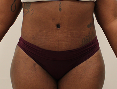 Tummy Tuck before and after - after