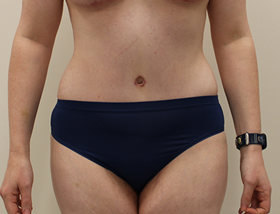 Tummy Tuck before and after - after