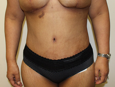 Tummy Tuck before and after - after