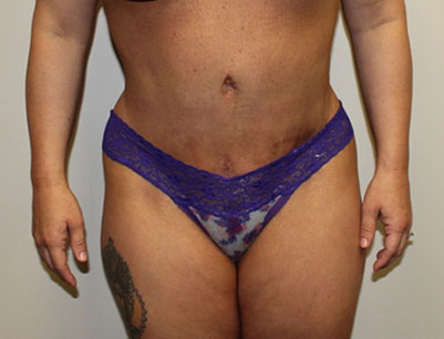 Tummy Tuck before and after - after