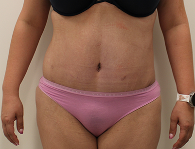 Tummy Tuck before and after - after