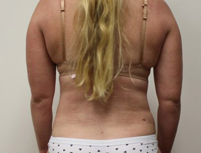 Liposuction before and after - after