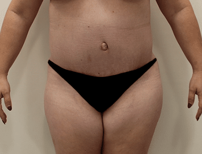 Tummy Tuck before and after - after