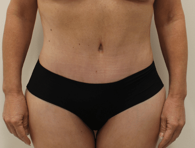 Tummy Tuck before and after - after