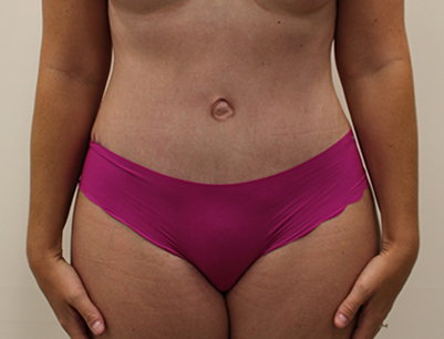 Tummy Tuck before and after - after