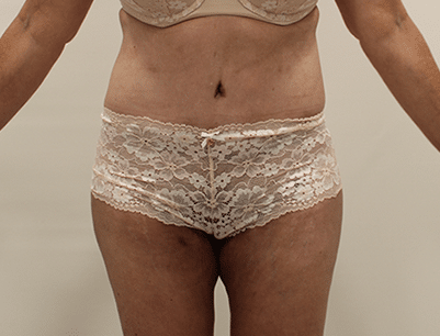 Tummy Tuck before and after - after
