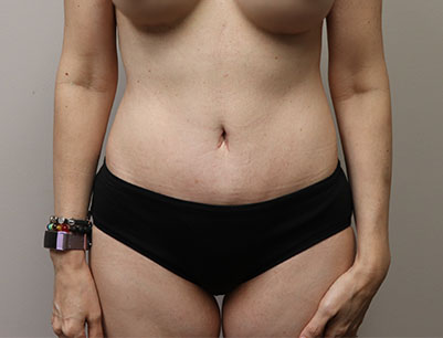 Tummy Tuck before and after - after