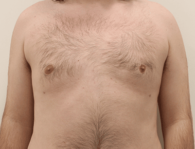 Liposuction before and after - after