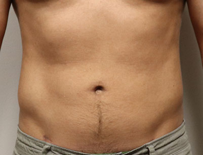 Liposuction before and after - after