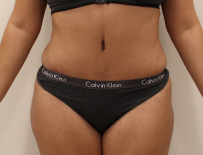 Tummy Tuck before and after - after