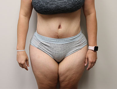 Tummy Tuck before and after - after