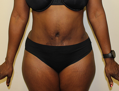 Tummy Tuck before and after - after