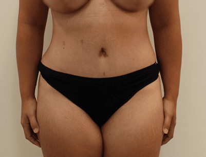 Tummy Tuck before and after - after