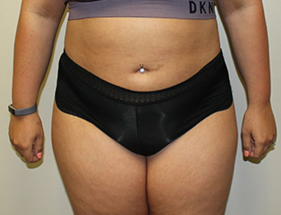 Liposuction before and after - after