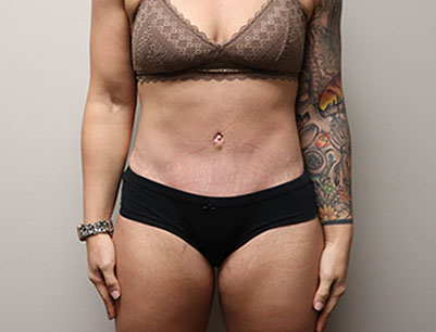 Tummy Tuck before and after - after