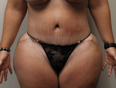 Tummy Tuck before and after - after