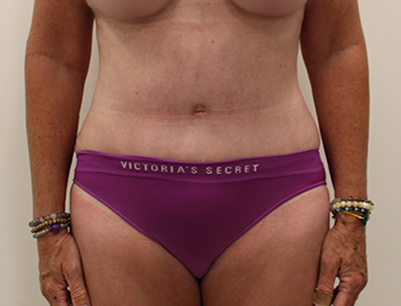 Tummy Tuck before and after - after