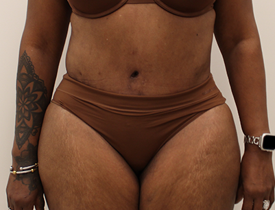 Tummy Tuck before and after - after