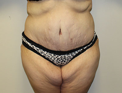 Tummy Tuck before and after - after