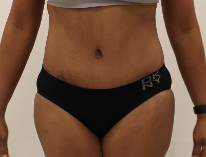 Tummy Tuck before and after - after