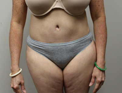 Tummy Tuck before and after - after