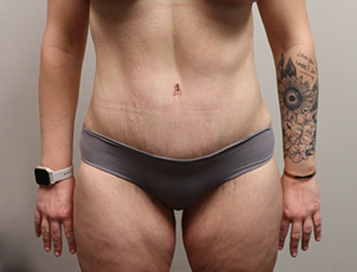 Tummy Tuck before and after - after