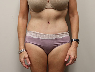 Tummy Tuck before and after - after