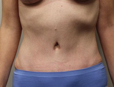 Tummy Tuck before and after - after