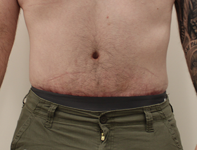 Tummy Tuck before and after - after