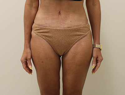Liposuction before and after - after
