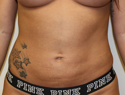 Liposuction before and after - after