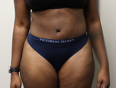 Tummy Tuck before and after - after