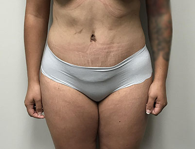 Tummy Tuck before and after - after