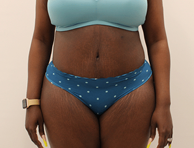 Tummy Tuck before and after - after