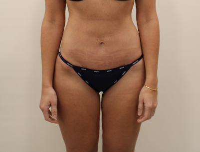 Liposuction before and after - after