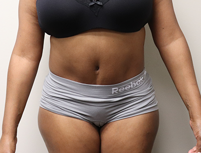 Tummy Tuck before and after - after