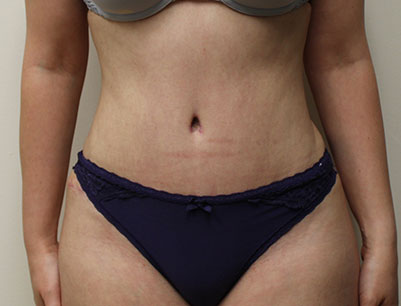 Tummy Tuck before and after - after