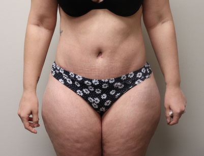 Tummy Tuck before and after - after
