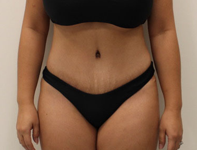 Tummy Tuck before and after - after