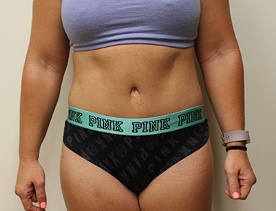 Tummy Tuck before and after - after