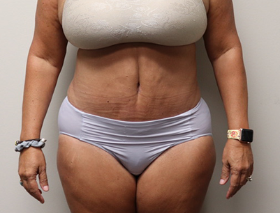 Tummy Tuck before and after - after